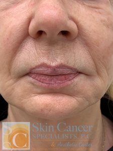 Filler around mouth-before