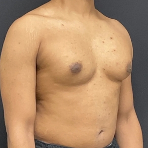 Lipo w BodyTite #9-before