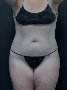 LAL upper+ lower abdomen + mini tummy tuck-after