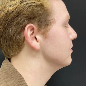 Lipo w Skin Tightening Face #6-after