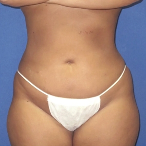 Patient 16: Upper/lower abdomen, flanks - 3 Months-after