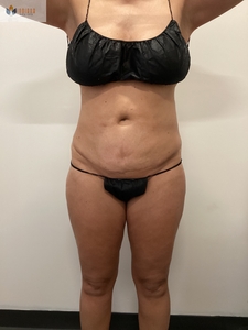 5 Sessions! Insta & Cryo Abdomen-before