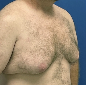 Male Breast Reduction #3-before