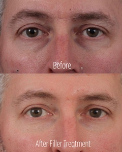 Filler SBA B/A 21-before