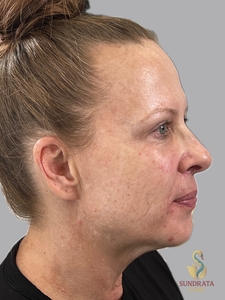 11 ML Cellenis Derma kit used to replace volume in tear troughs, cheeks and Nasolabial folds-after