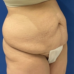 Mommy Makeover #9-before