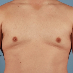Male Breast Reduction #12 (front)-after