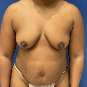 Mommy Makeover #8-before