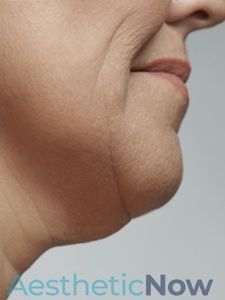 Kybella-before