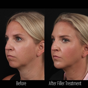 Filler B/A SBA 7-before