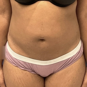 Lipo w Renuvion #10-before