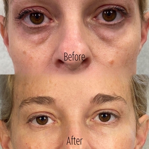 Filler B/A SBA 40-before