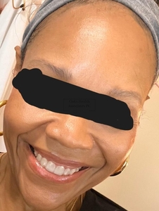 Xeomin (Neurotoxin) for Forehead Lines-before