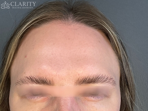 Daxxify: Frontalis-after