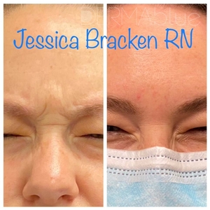 Botox 18-before