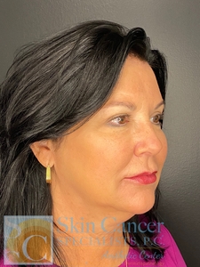 Nova Threads and Voluma Filler-after