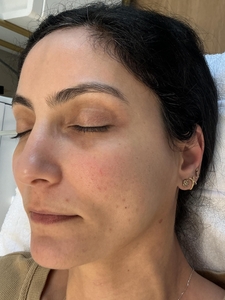 Rita B&A SkinPen-after