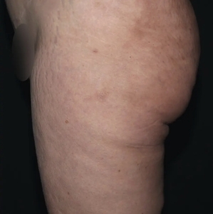 Cellulite Reduction #1-after