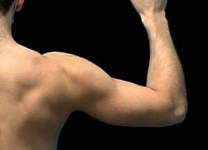 Emsculpt NEO #2-before