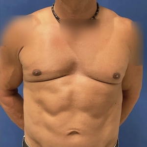 Male Breast Reduction #4 (front)-after