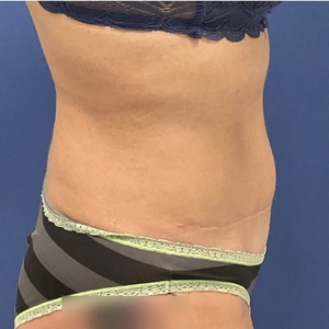 Tummy Tuck #15-after
