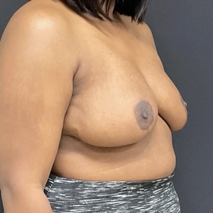 Breast Reduction #1-after
