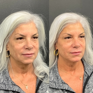 Face balancing-before