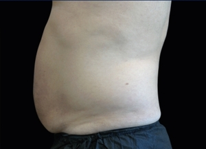 Emsculpt NEO #5-after