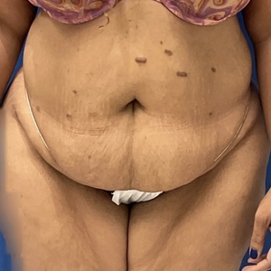 Tummy Tuck #12-before