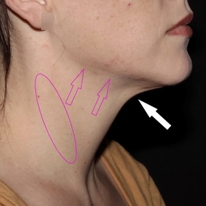 Lipo w Skin Tightening Face #4-after