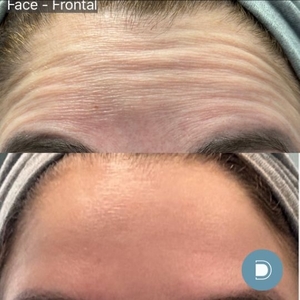 Botox-before