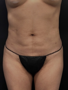 LAL-lower abdomen + waist-after