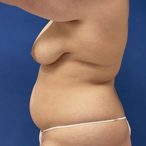 Mommy Makeover #7-before