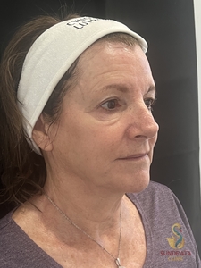 One XERF treatment-after