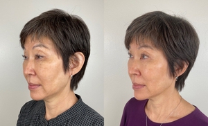 SCULPTRA  (2 VIALS)-before