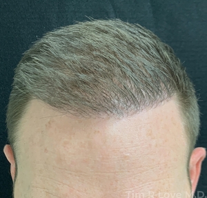 3600 grafts done in 2 sessions over a 5 year period-after
