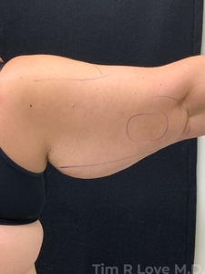 Brachioplasty-before