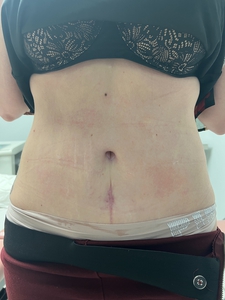 Skin tyte skin tightening for abdomen-before
