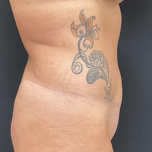 Tummy Tuck #10-after