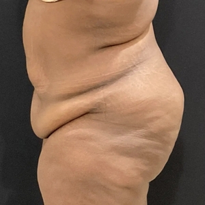 Tummy Tuck #4-before