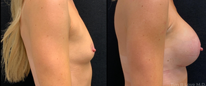 5'8 130# Patient is 1mo po breast aug w/shaped memory gel implants 390 CC HP-before