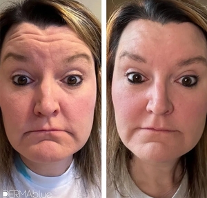 Botox-before