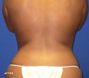 Liposuction #1-after