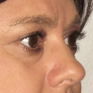 Brow & Eye Lift #5-before