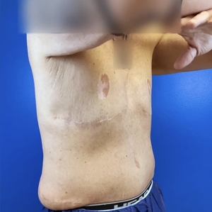 Male Breast Reduction #6-after