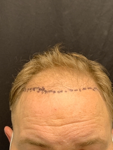 Neograft 1753 grafts-after