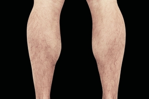 4 Treatments-after