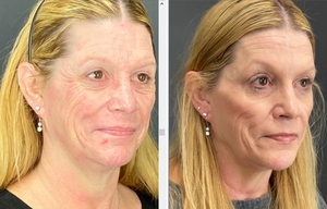 Botox - 20 u forehead, 24 u cf-before