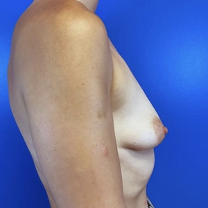 Breast Augmentation #1 355 cc-before