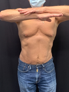 Male LAL lower abdomen + waist-before